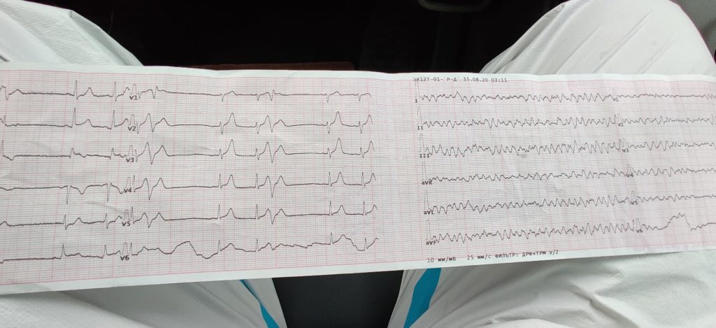 В Тверской области врачи спасли мужчину после клинической смерти
