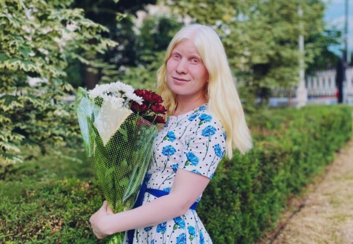 Жизнь без меланина: На Первом канале вышел сюжет об альбиносе из Твери Жизнь без меланина: На Первом канале вышел сюжет об альбиносе из Твери