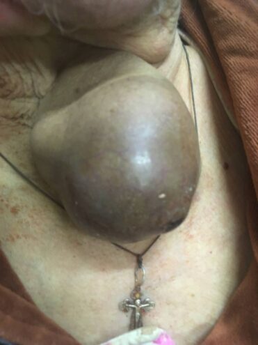 В Твери врачи удалили у пенсионерки большую опухоль В Твери врачи удалили у пенсионерки большую опухоль